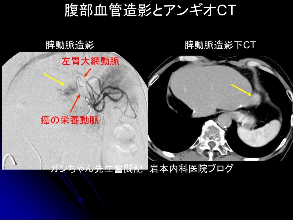 Spleen angio CT